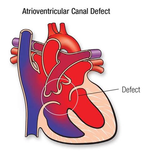 causes faux diagnostic echo canal atrio ventriculaie